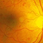 Diabetic Retinopathy