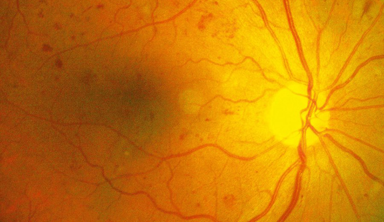 Diabetic Retinopathy